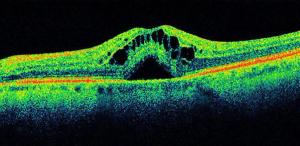 ASRS 2020: New imaging modalities offering bold, noninvasive, real-time monitoring of retinal diseases