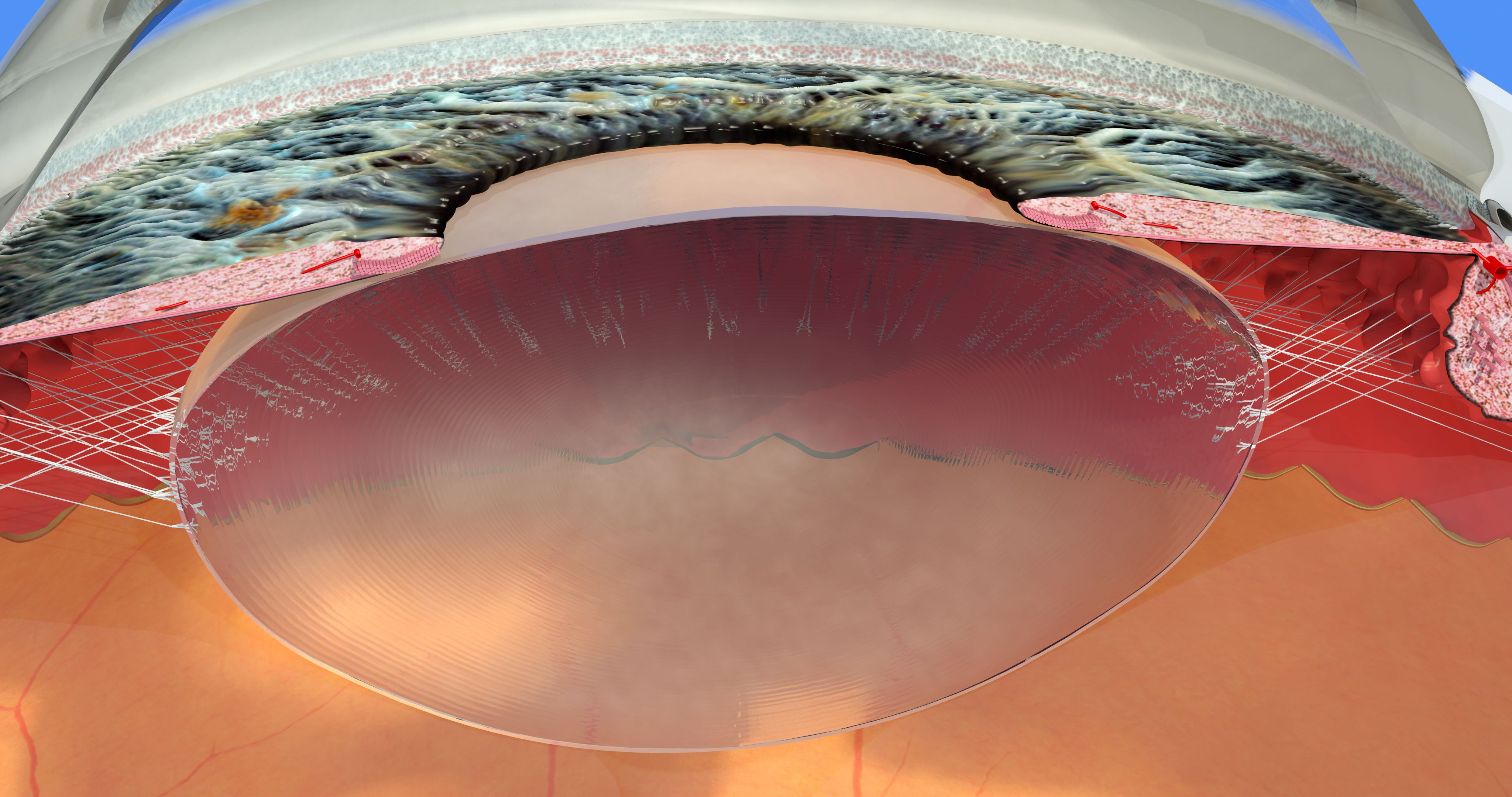 Strategies for managing strabismus after repair of retinal detachments
