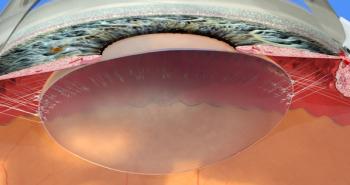 Strategies for managing strabismus after repair of retinal detachments