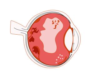 Considering YAG vitreolysis for persistent vitreous floaters