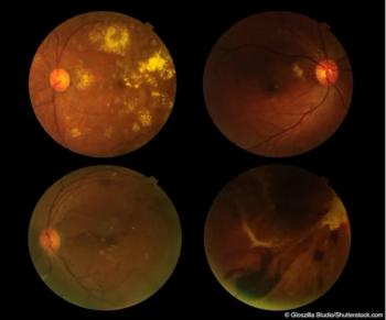 early switch of anti-VEGF drugs
