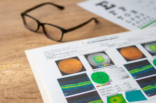 (Image credit: AdobeStock/izzuan) Retina World Congress 2026: Rethinking macular hole surgery without gas tamponade