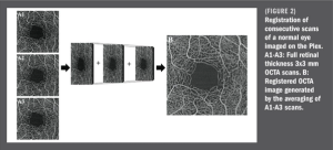Parafoveal retinal vessel density assessment by OCTA in healthy eyes