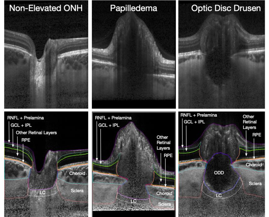 A field guide to optic disc drusen
