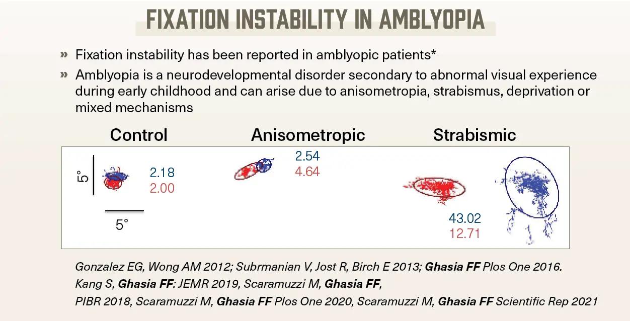 Fixation instability in amblyopia