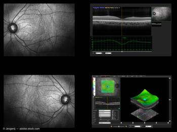 Optical coherence tomography (OCT)