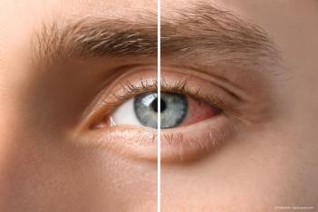 Successful ocular surgery in patients with chronic uveitis