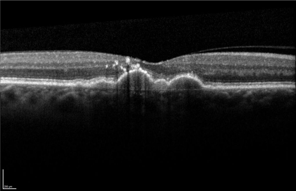Figure 4. Hyper-reflective foci are a type of retinal pigment epithelium (RPE) that slough off in association with drusen and migrate into the retina. (Images courtesy of Karl G. Csaky, MD, PhD)