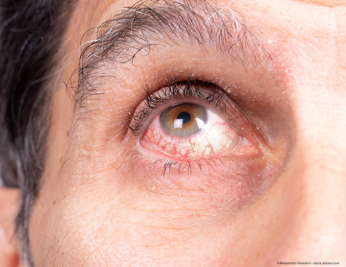 Pearls for recognizing and treating uveitis