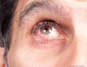 Pearls for recognizing and treating uveitis