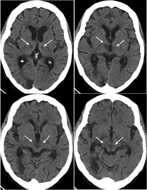 Loss of Consciousness in an Elderly Woman With Prior CVA: What Cause?