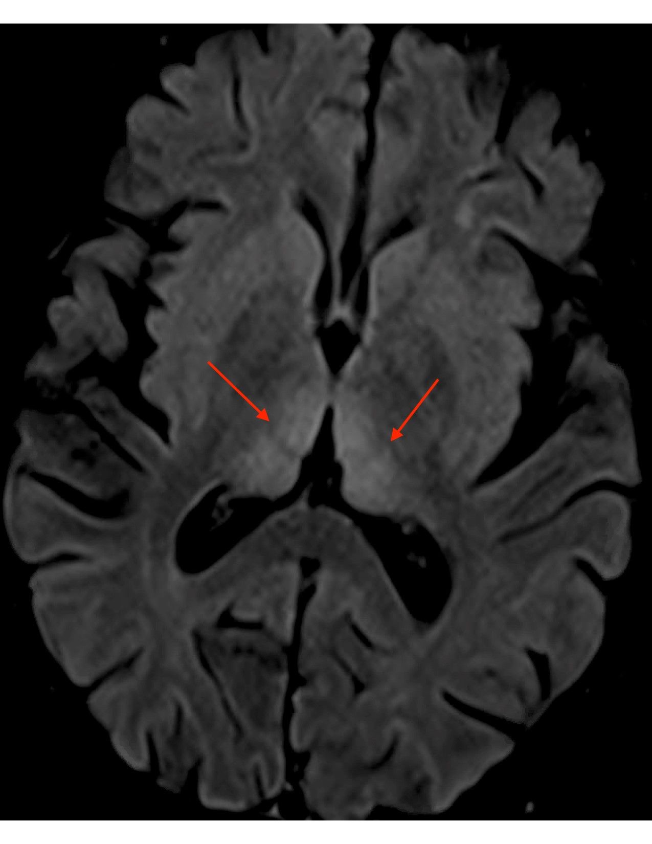 MRI brain scan axial FLAIR increased signal periaqueductal gray matter