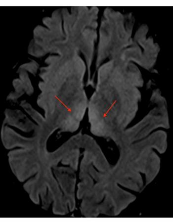 MRI brain scan axial FLAIR periaqueductal gray matter