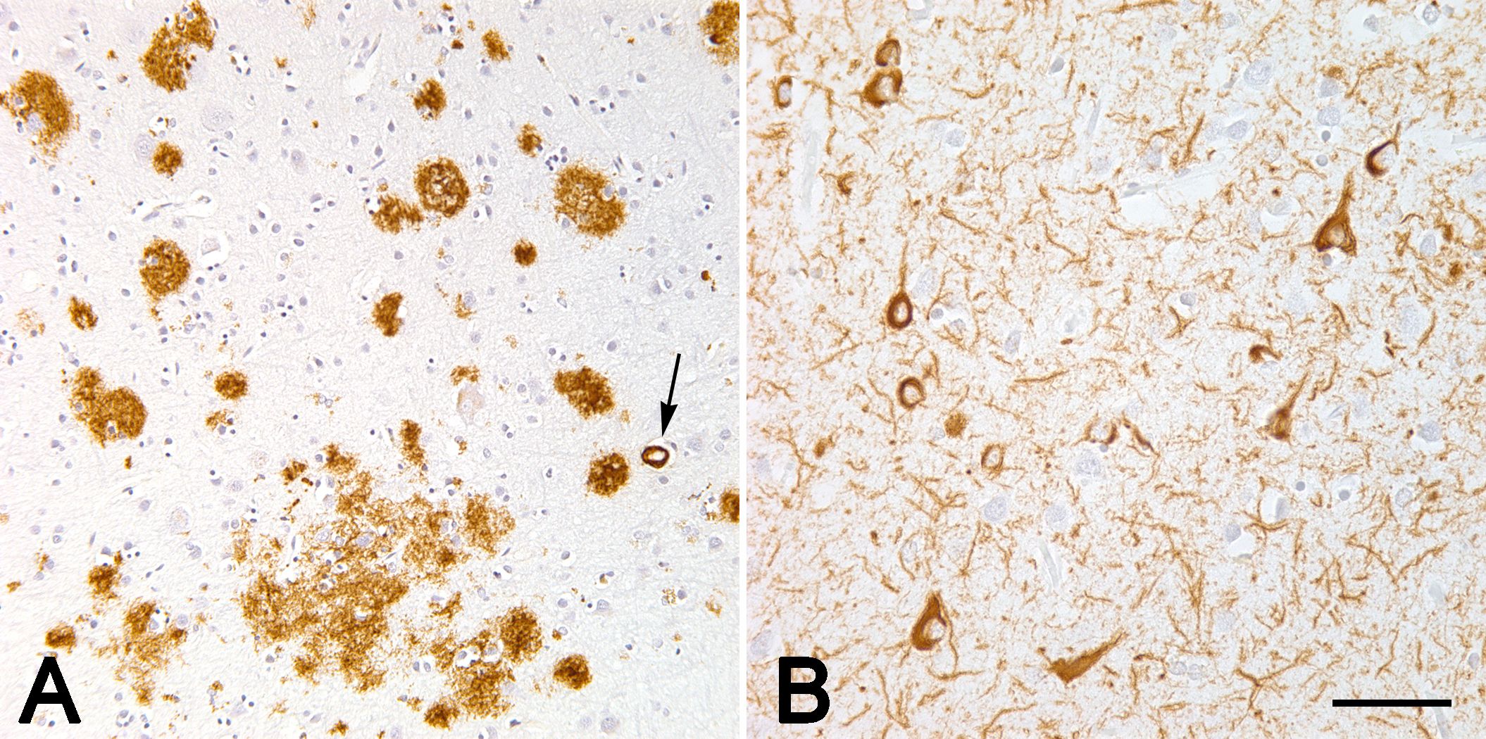 Aβ-proteopathy and tauopathy in the neocortex of an Alzheimer patient