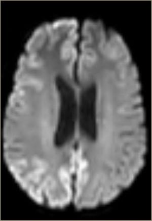 Case Study: Creutzfeldt-Jakob Disease Confirmed With RT QuIC