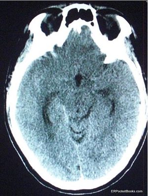 Subarachnoid hemorrhage CT scan of head