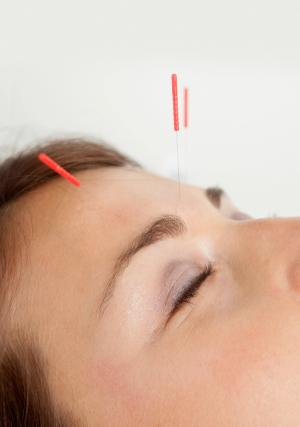 Acupuncture for Migraine