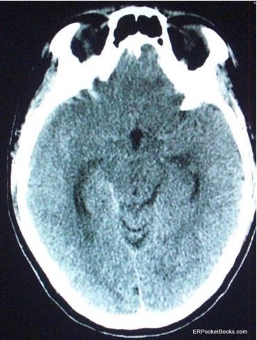 Subarachnoid hemorrhage, CT scan of head 