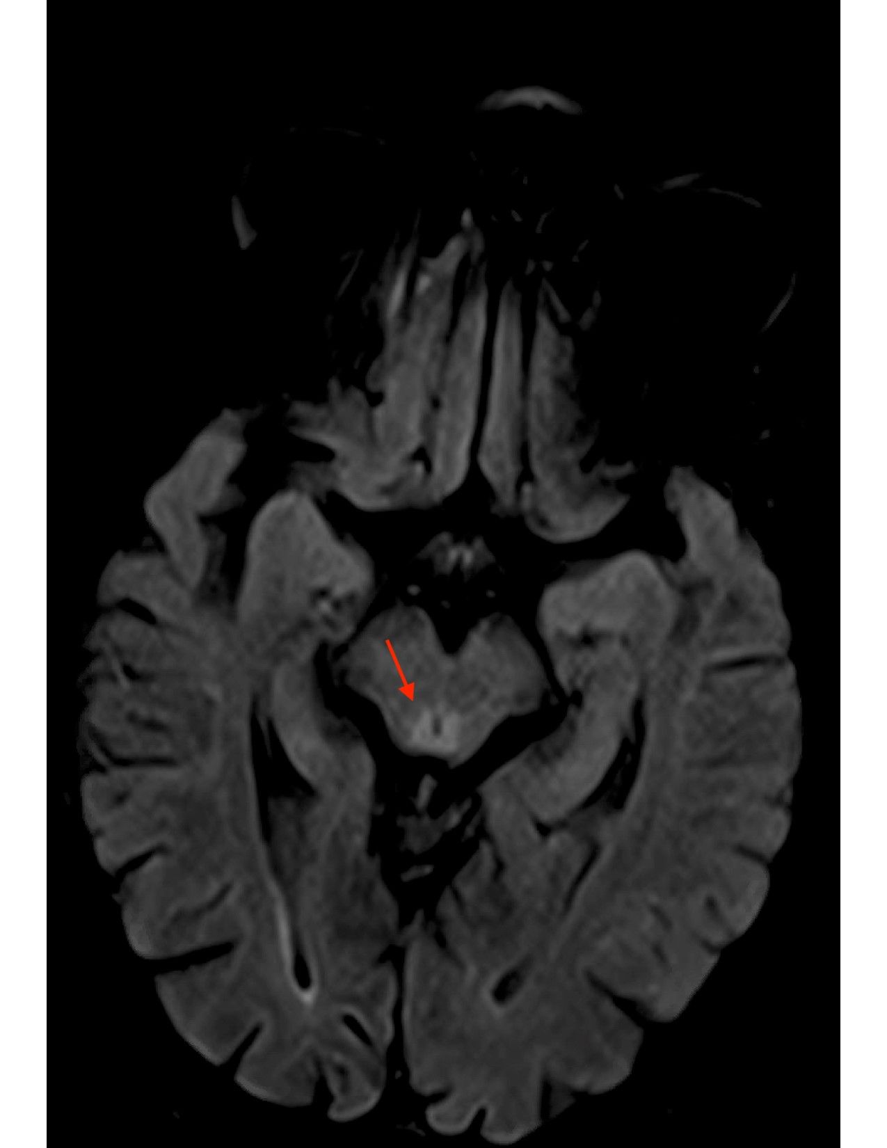 MRI brain scan axial FLAIR increased signal bilateral thalami