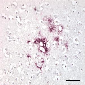 aberrant prion proteins accumulate in the nervous system