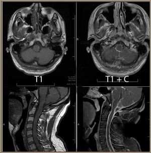 Differential Diagnosis of Meningitis and Encephalitis