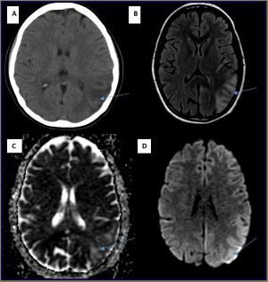 Diagnosing and Treating MELAS: Issues for Clinicians