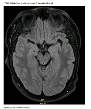 Case Report: Unusual New Onset Seizures