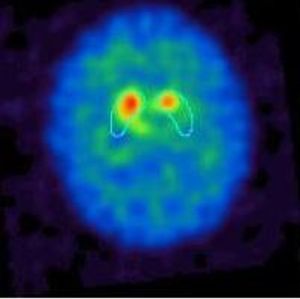 Idiopathic Parkinson: Diagnosis of the Deceptive