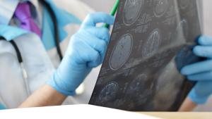 AAN Guidelines on Use of fMRI for Presurgical Mapping in Epilepsy