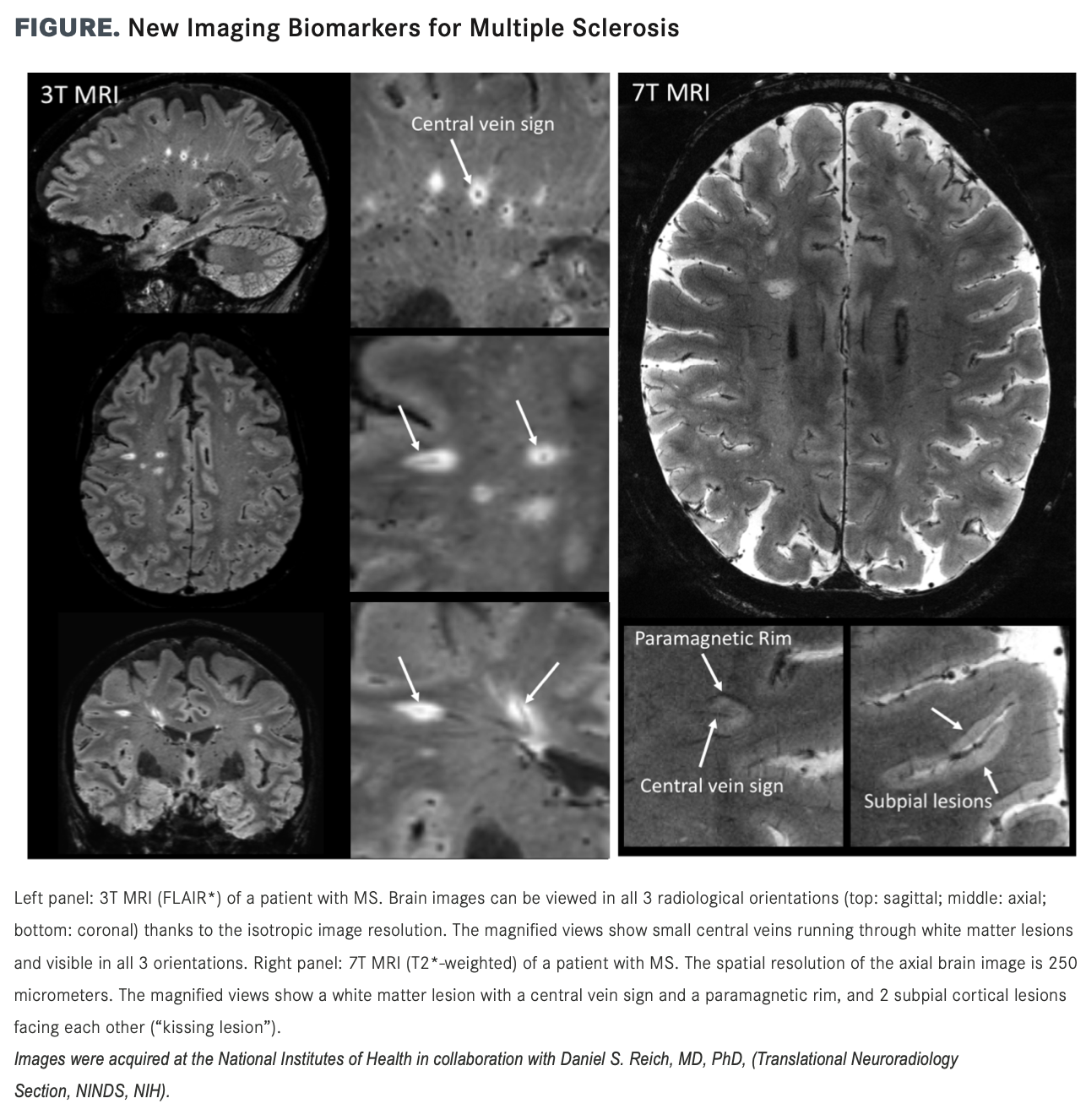Advanced Ms Mri Ms Brain Mri With Contrast