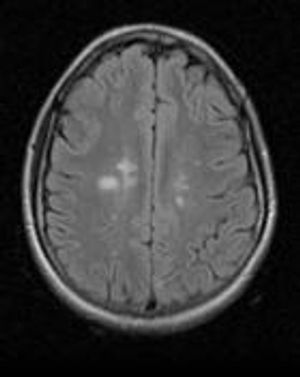 Multiple Sclerosis and the Radiologically Isolated Syndrome 