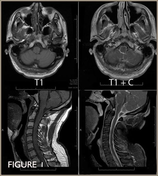 Differential Diagnosis of Meningitis and Encephalitis