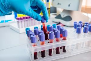 Evaluation of PACAP Levels in Chronic Migraine