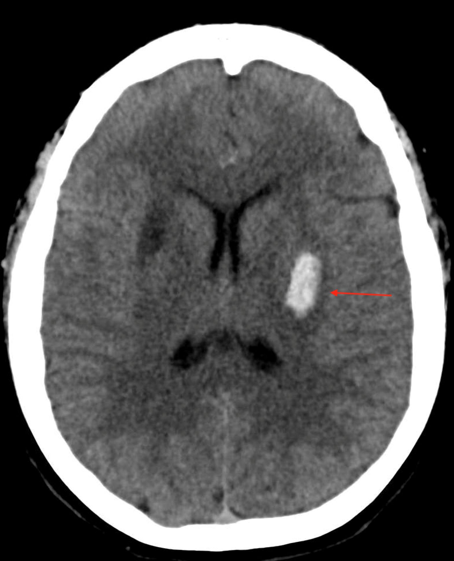 Ischemic and hemorrhagic stroke