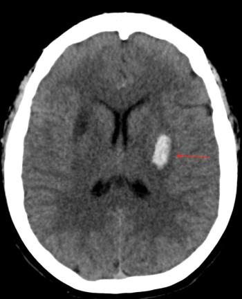 Ischemic and hemorrhagic stroke