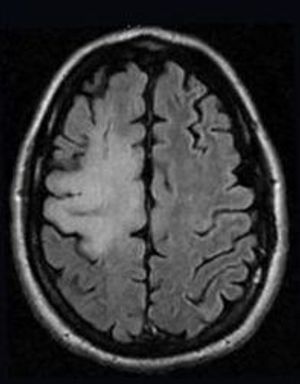 A Case of PML-IRIS: Diagnostic and Treatment Considerations