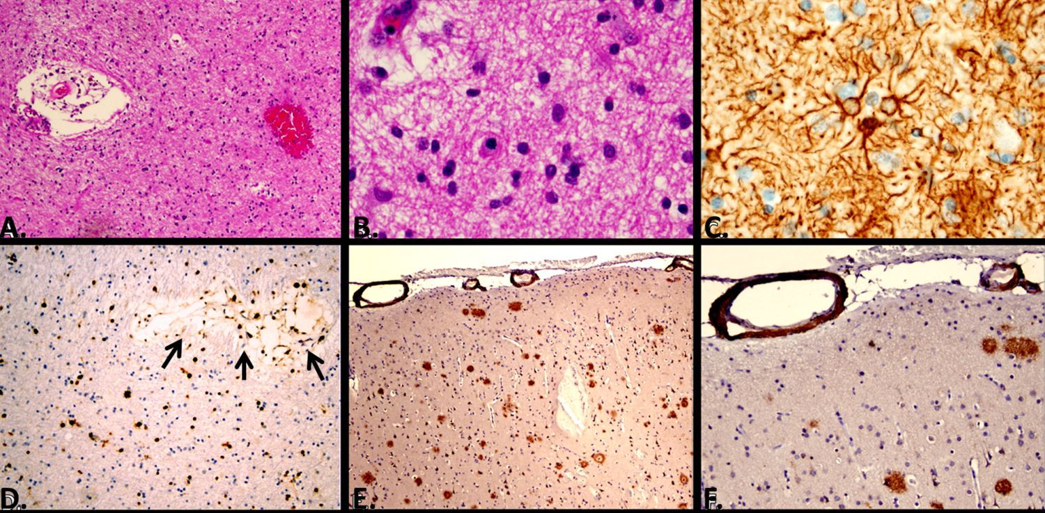 Figure 2. Neuropathology from right temporal lobe biopsy
