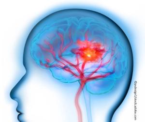Cerebral Venous Thrombosis
