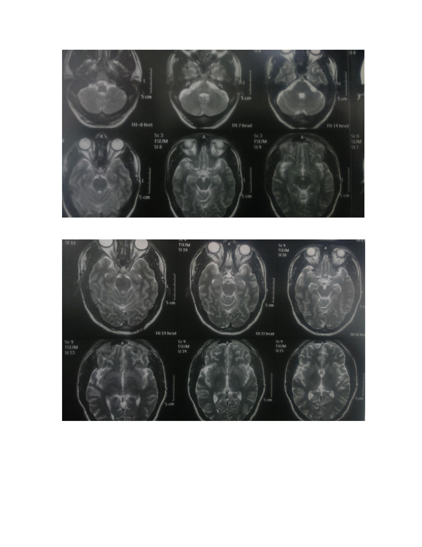 Effective Treatment Of Essential Palatal Tremor And Coexistent Bipolar Disorder A Case Report