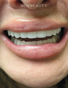 Dr. Lana Rozenberg – Smile Makeover – 47194502 - After