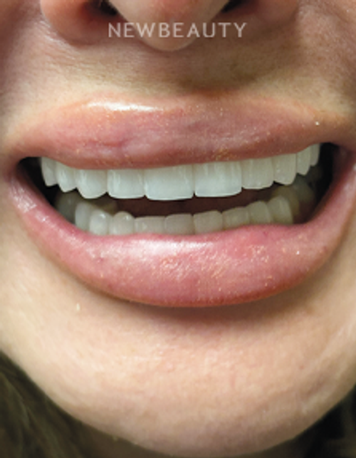 Dr. Lana Rozenberg – Smile Makeover – 47194502 - After