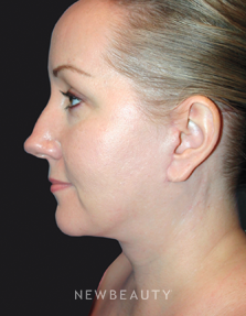 Dr. Kelly Bomer Facelift, Neck lift - After