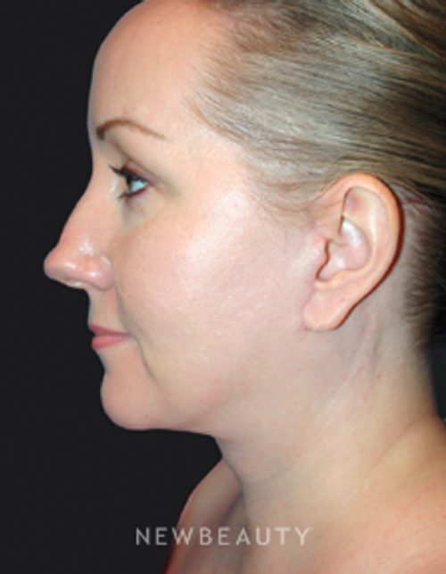 Dr. Kelly Bomer Facelift, Neck lift - After