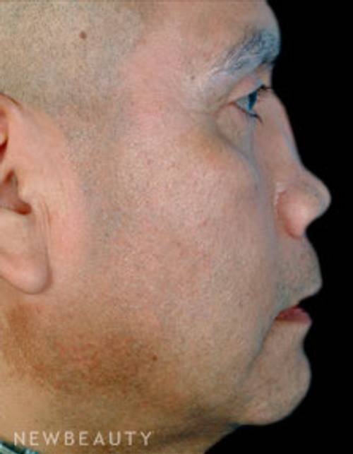 Dr. David Kim Rhinoplasty - Before