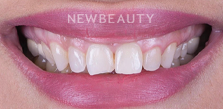 Dr. Husam Almunajed - Gum Lift & Veneers - 32922683 - Before