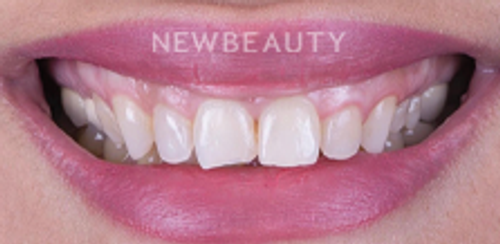 Dr. Husam Almunajed - Gum Lift & Veneers - 32922683 - Before