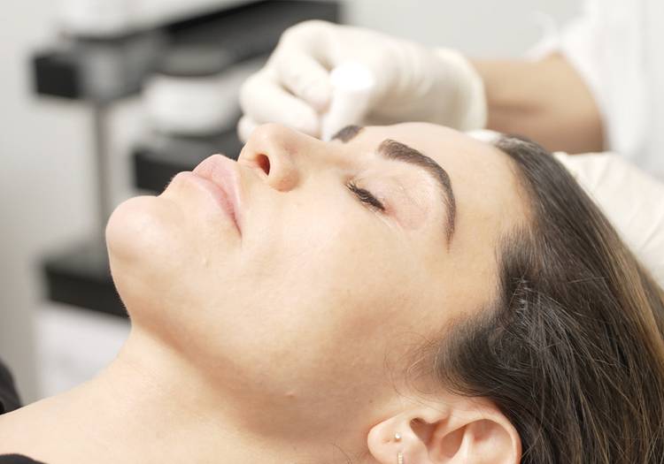 The PCA SKIN Peel That’s Changing the Game for Melasma and Dark Spots