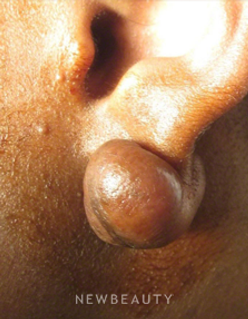 Dr. Kally Papantoniou - Earlobe Repair - Before
