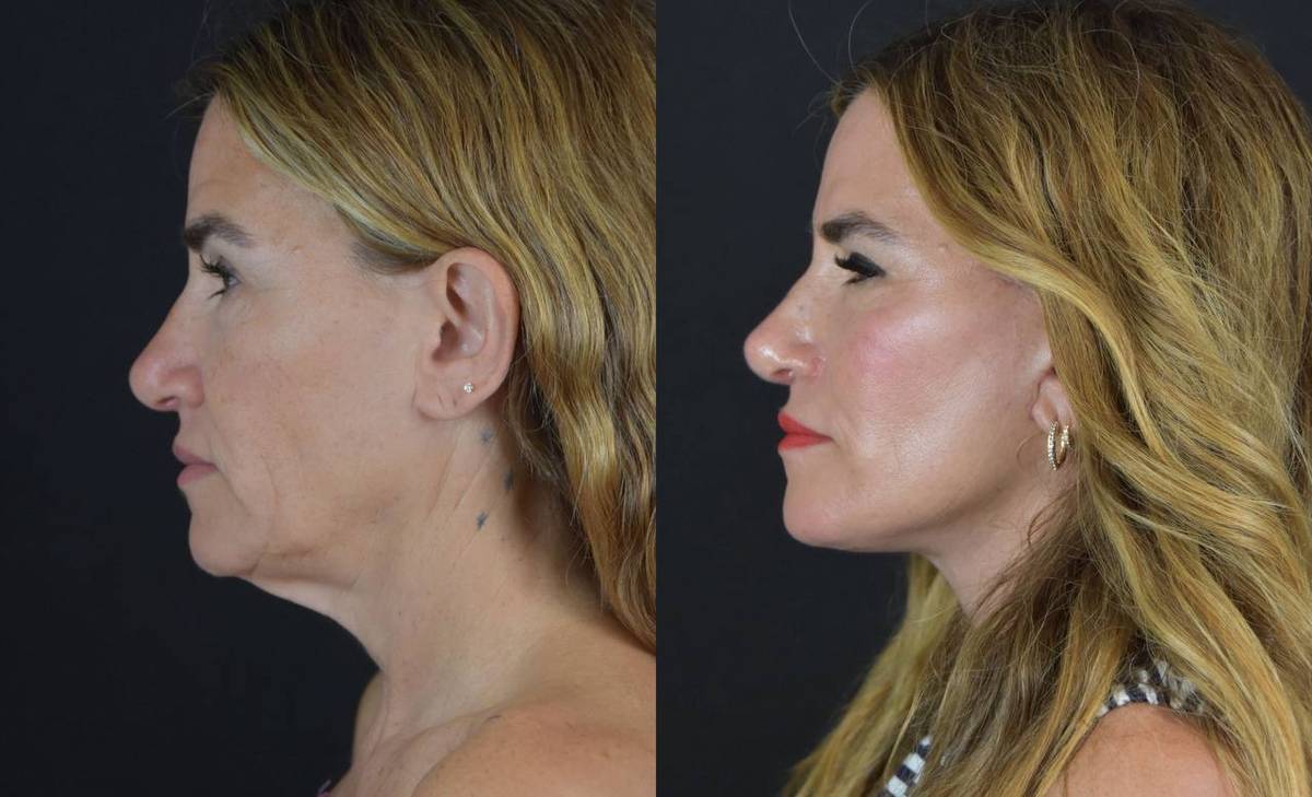 alli webb facelift side profile