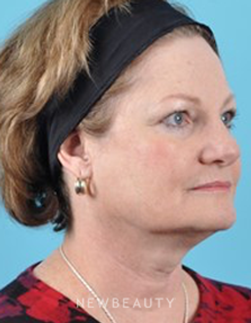 Dr. Brad Bengtson - Facelift - Before